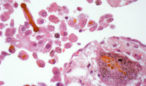 mesothelioma-2