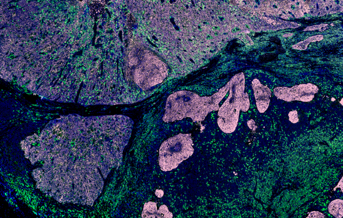 How Scottish scientists are developing Artificial Intelligence for assessing Mesothelioma