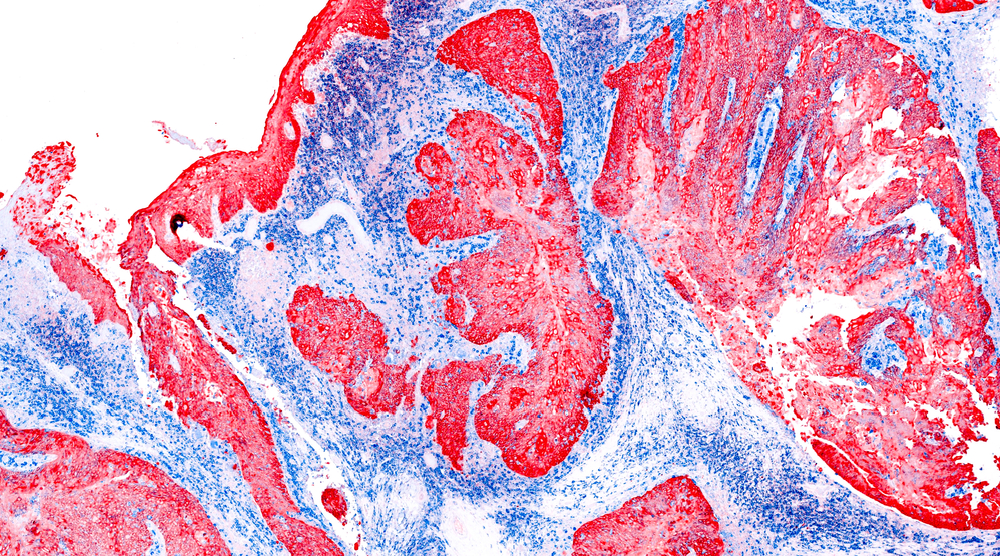 Asbestos cancer mesothelioma deaths at record high in the South West